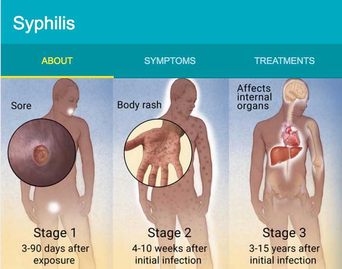 Difference stages of syphilis infection, different symptoms